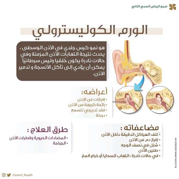 «فهد الطبية» تحذر من إهمال علاج الورم الكوليسترولي