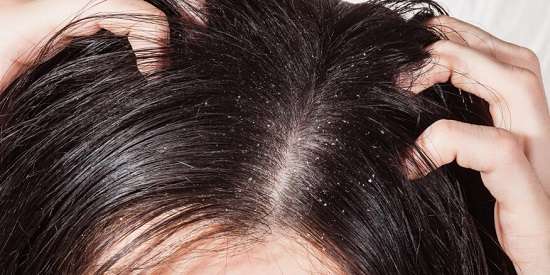 3 وصفات طبيعية للتخلص من قشرة الشعر