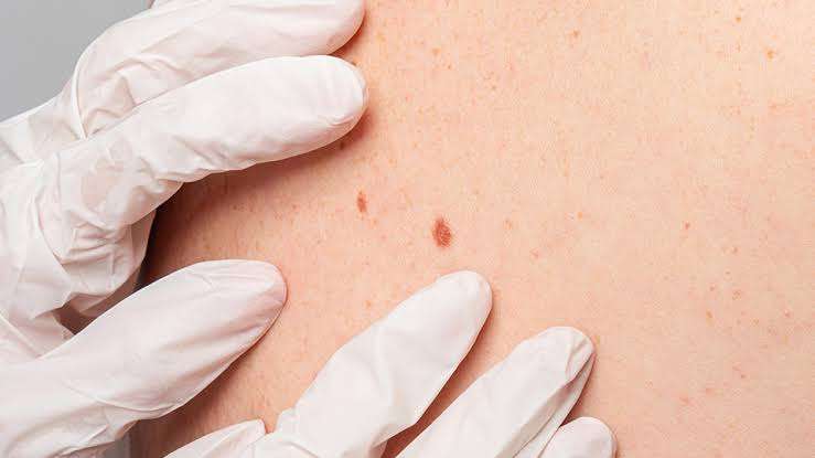 أنواع سرطان الجلد وأماكن الإصابة بها وأعراضها